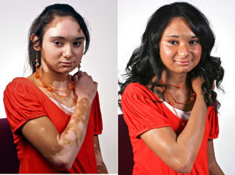 Best Vitiligo Treatment