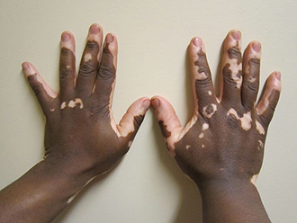 New Vitiligo Treatment