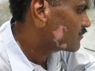 Vitiligo Treatment UK